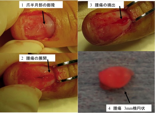 爪の部分が当たったり 触れると痛い 爪下グロームス腫瘍 古東整形外科 リウマチ科
