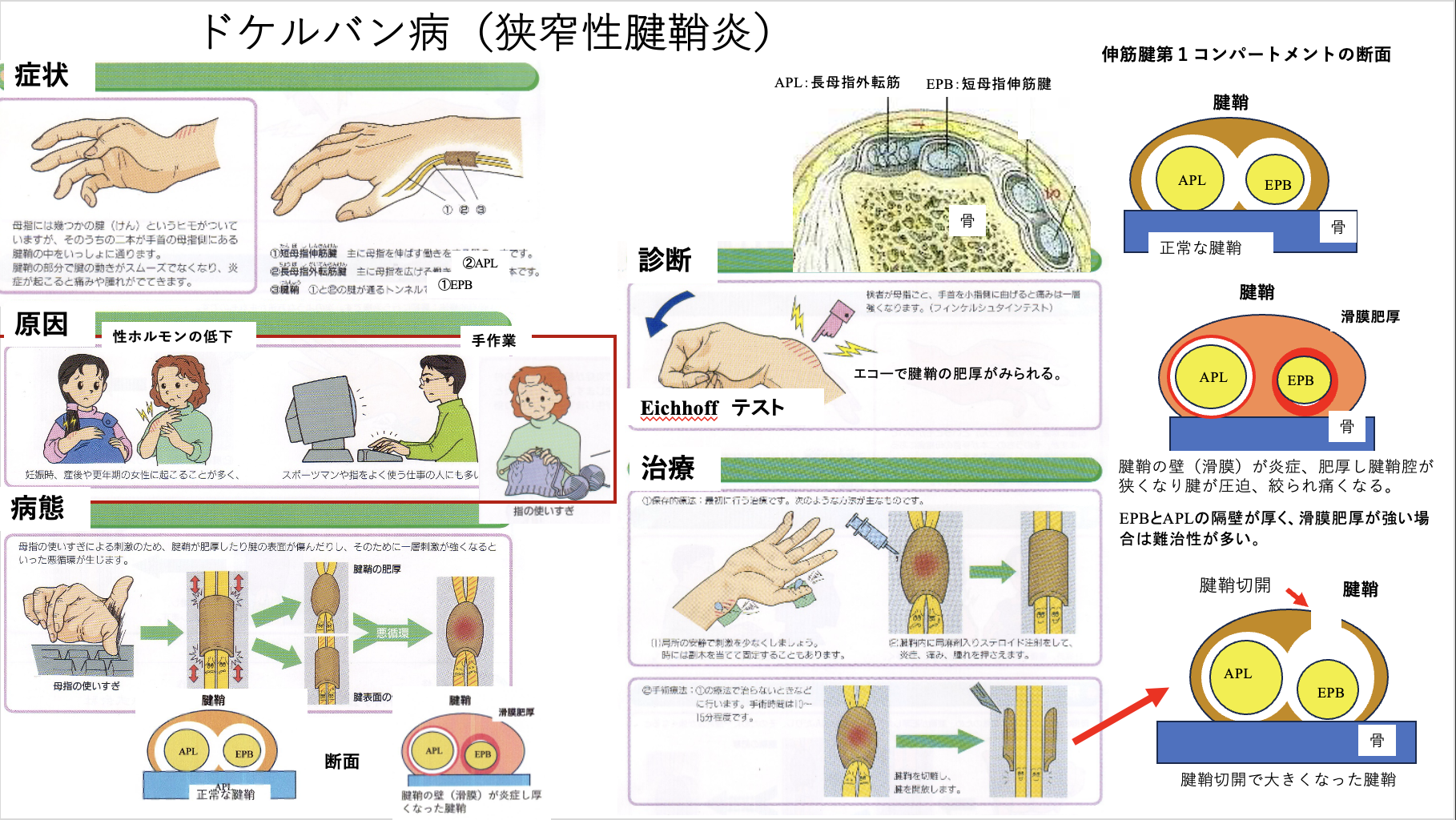 GULL - 腱鞘炎 ドケルバン病（腱鞘炎） - 大阪府高槻市・JR高槻駅から徒歩5分に