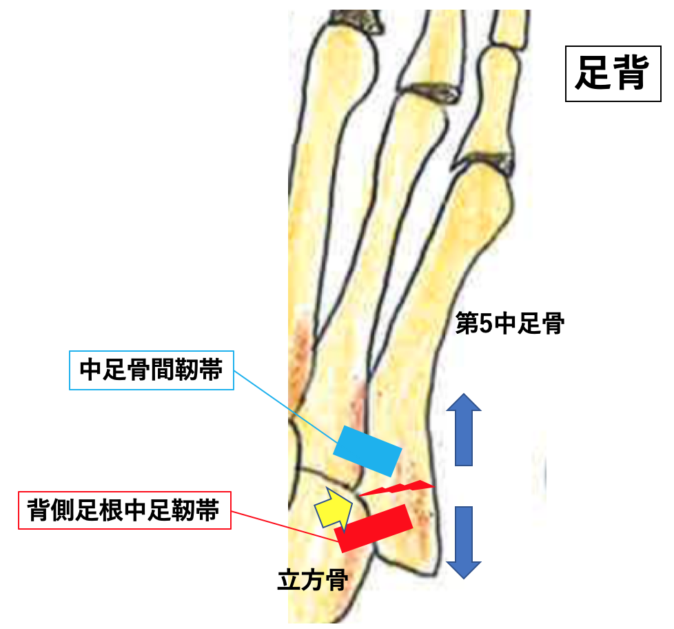 第5中足骨基部骨折 Jones骨折 外傷性および疲労性骨折が難治性である理由 古東整形外科 リウマチ科