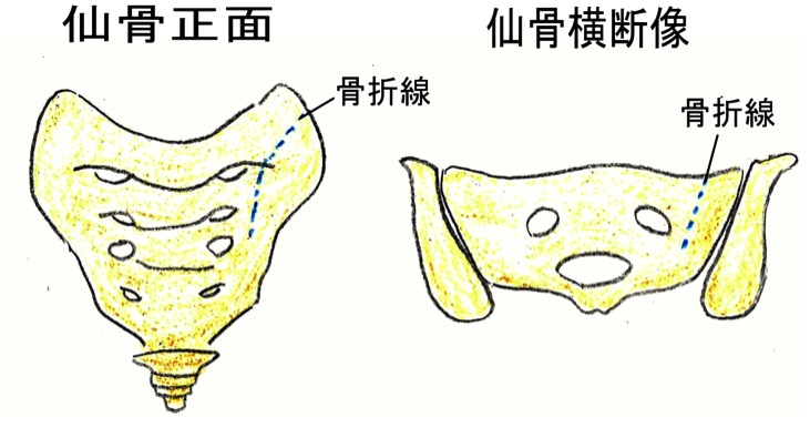 仙骨疲労骨折 古東整形外科 リウマチ科