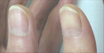 爪の部分が当たったり 触れると痛い 爪下グロームス腫瘍 古東整形外科 リウマチ科