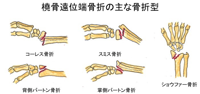 橈骨遠位端骨折 スリング 販売