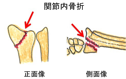 橈骨遠位端骨折の保存療法 - 古東整形外科・リウマチ科