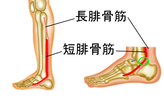 外傷性腓骨筋腱脱臼 腓骨筋腱脱臼に対するギプス固定による治療 古東整形外科 リウマチ科