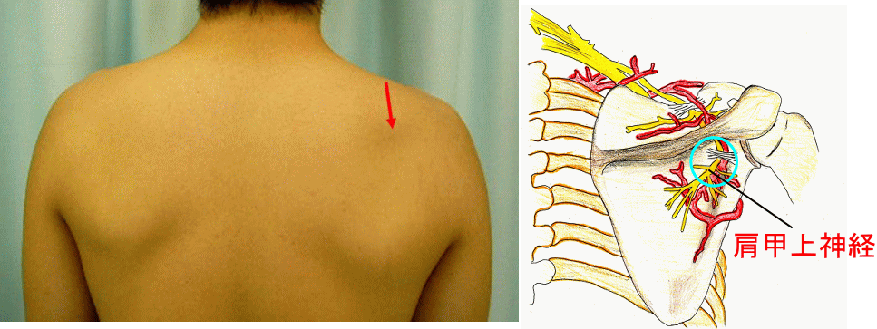 肩甲上神経麻痺 けんこうじょうしんけいまひ 古東整形外科 リウマチ科