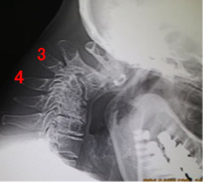 頚椎圧迫骨折 （頚椎骨脆弱性骨折） - 古東整形外科・リウマチ科
