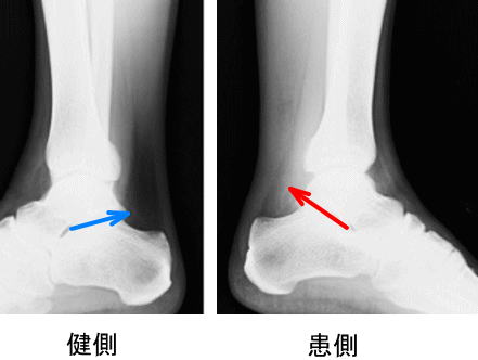 アキレス腱断裂の症例 古東整形外科 リウマチ科