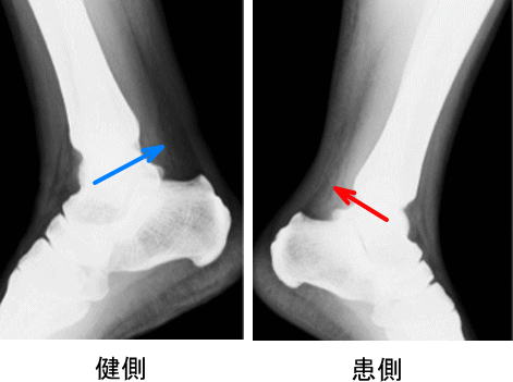 アキレス腱断裂の症例 古東整形外科 リウマチ科