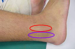 外傷性腓骨筋腱脱臼 腓骨筋腱脱臼に対するギプス固定による治療 古東整形外科 リウマチ科