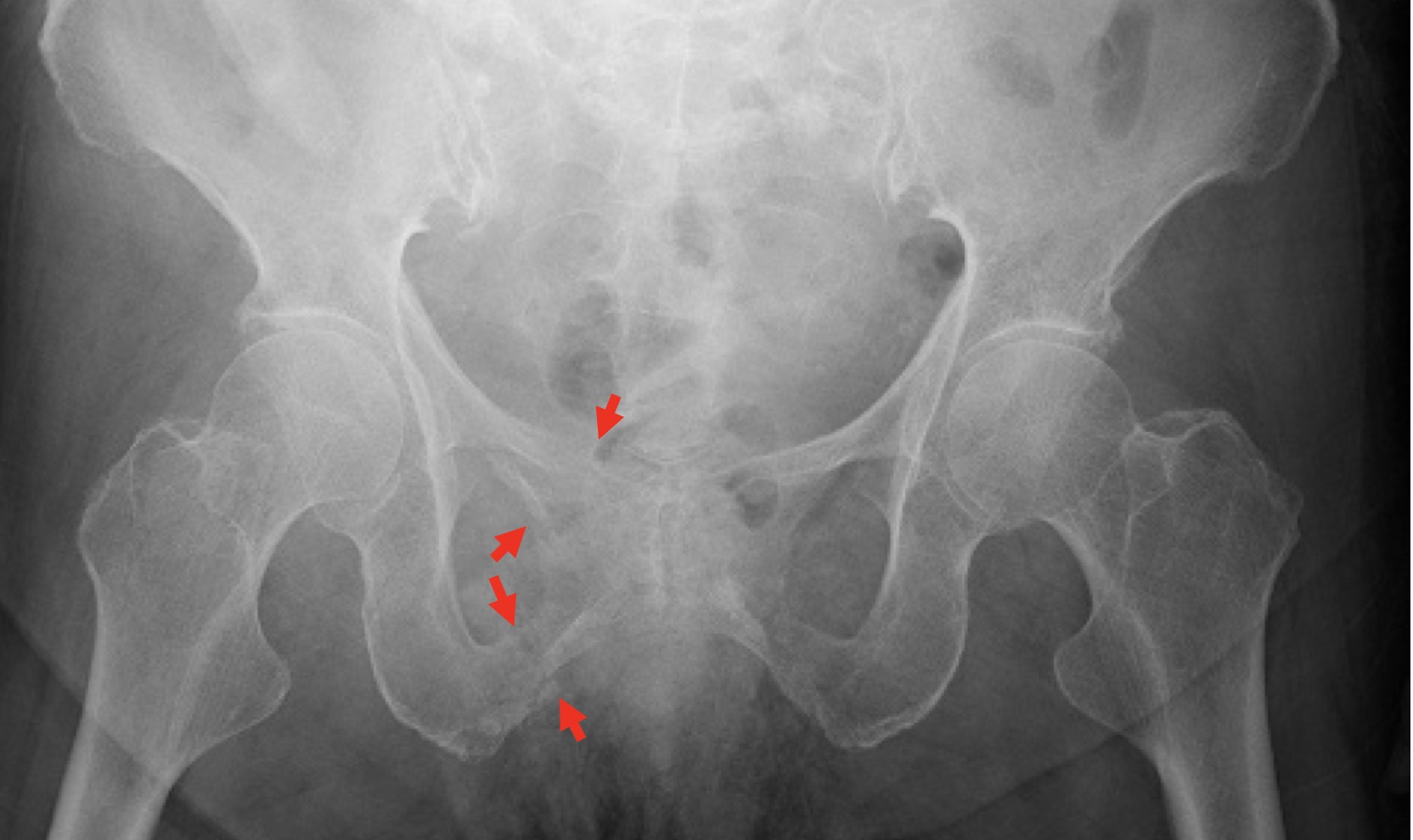 骨盤・股関節周辺に見られる骨脆弱性骨折 古東整形外科・リウマチ科