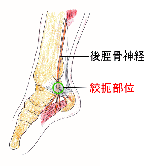 足根管症候群 そくこんかんしょうこうぐん 古東整形外科 リウマチ科