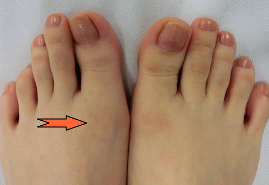 強剛母趾の保存療法 足底板療法 テニス中の親指の痛みを軽減できた症例 古東整形外科 リウマチ科