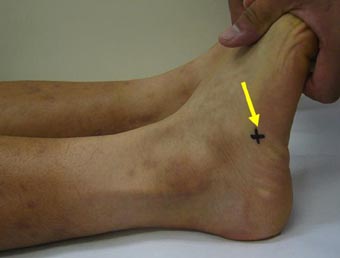 ランニングによる 足の外側の痛み 短腓骨筋腱付着部炎 古東整形外科 リウマチ科