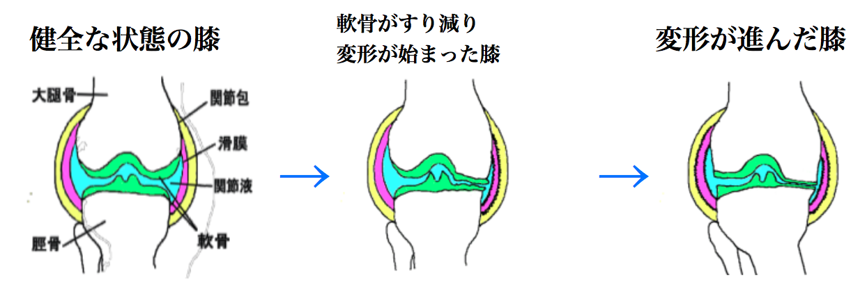 人工膝関節置換術 TKA（変形性膝関節症の手術療法） - 古東整形外科 