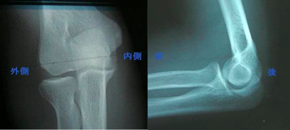 上腕骨内側上顆裂離骨折 肘が痛くて 投球できない 古東整形外科 リウマチ科