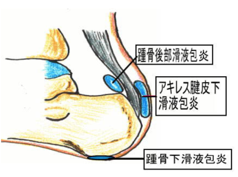 膝 足首 肘をつくと痛いんだけど 実はお尻も 滑液包炎シリーズ 古東整形外科 リウマチ科