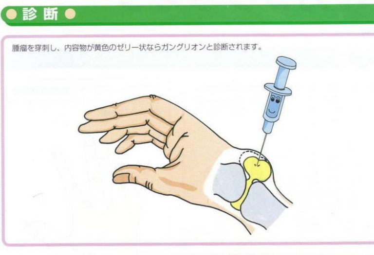 ガングリオン嚢胞とは何ですか?