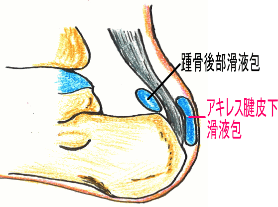 踵が靴に当たって腫れて痛い アキレス腱皮下滑液包炎 古東整形外科 リウマチ科