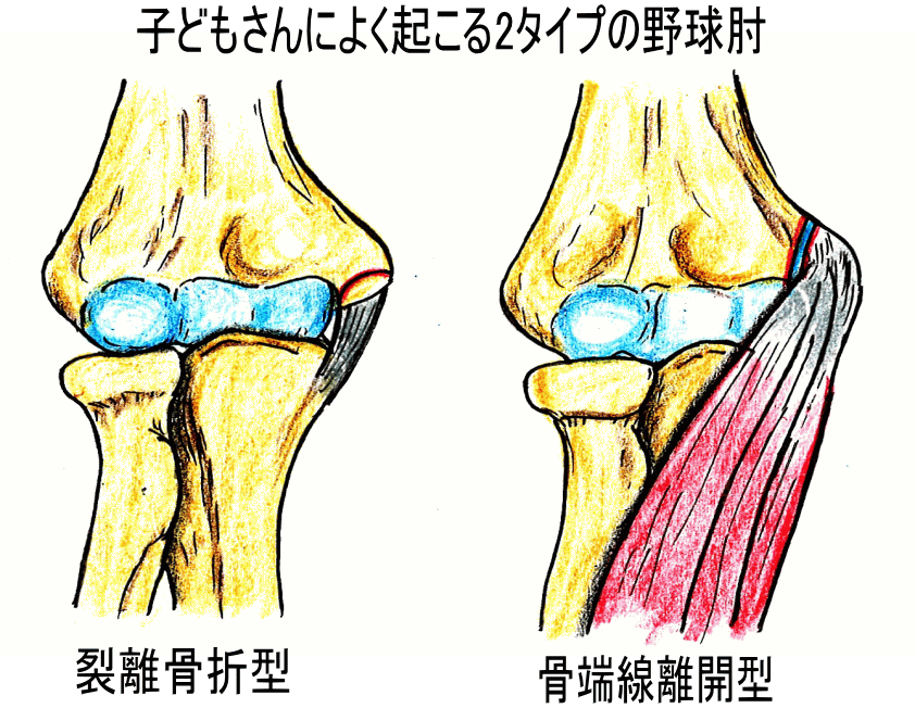 上腕骨内側上顆裂離骨折 肘が痛くて 投球できない 古東整形外科 リウマチ科