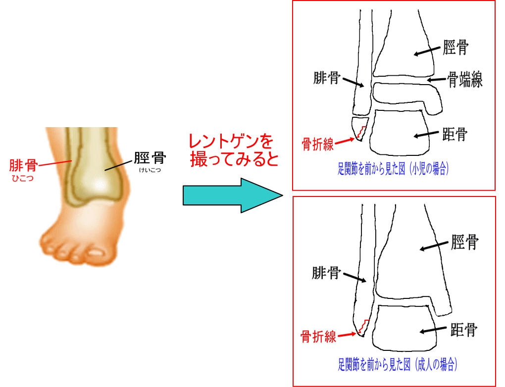 足首の捻挫と思っていたら骨折だった 腓骨遠位端骨折 古東整形外科 リウマチ科