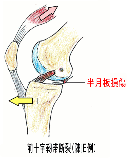 前十字靱帯損傷 前十字靱帯損傷の 診断と合併症 古東整形外科 リウマチ科