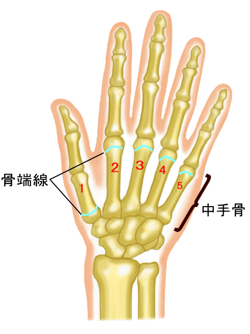 中手骨骨端線損傷 ちゅうしゅこつこつたんせんそんしょう 古東整形外科 リウマチ科
