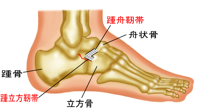 踵骨前方突起骨折 古東整形外科 リウマチ科
