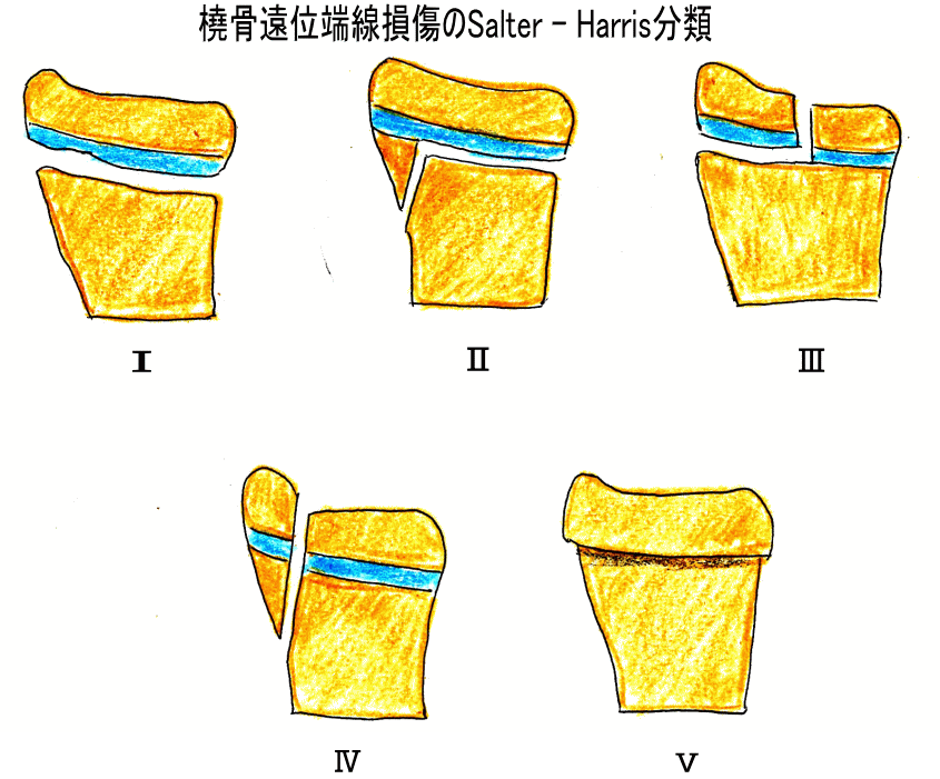 橈骨遠位骨端線損傷 古東整形外科 リウマチ科