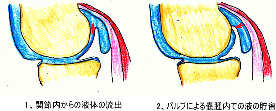 ベーカー嚢腫とは何ですか