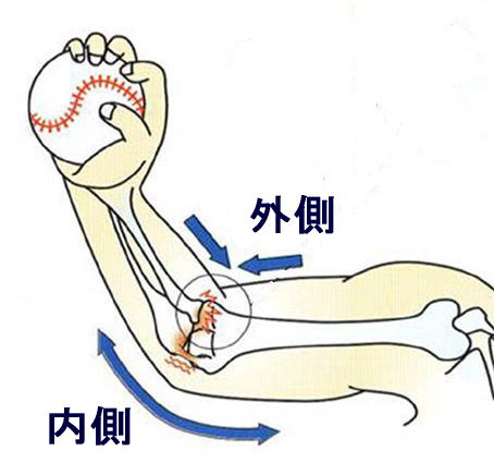 肘 痛み 野球