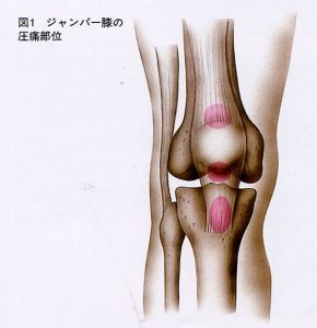 ジャンパー膝 膝蓋靭帯炎 ジャンプすると膝が痛い 古東整形外科 リウマチ科