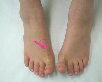 足の腱鞘炎 靴が原因で足が痛い 古東整形外科 リウマチ科