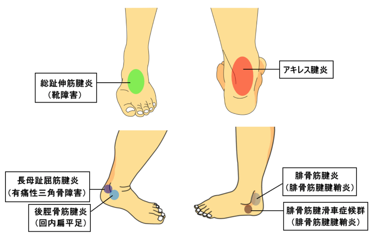足 の 甲 腱鞘炎