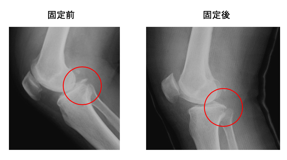 後十字靭帯付着部裂離骨折 膝の打撲と思っていたら骨折だった 古東整形外科 リウマチ科