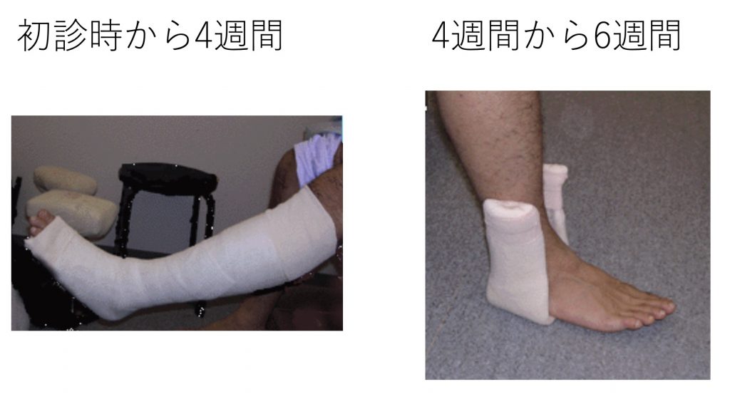 腓骨遠位端骨折 捻挫による足関節の骨折 古東整形外科 リウマチ科