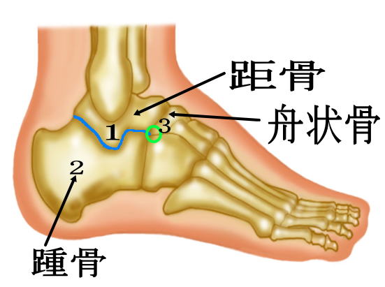 足根骨癒合症 足首の捻挫と思っていたら こんな病気が見つかった 古東整形外科 リウマチ科