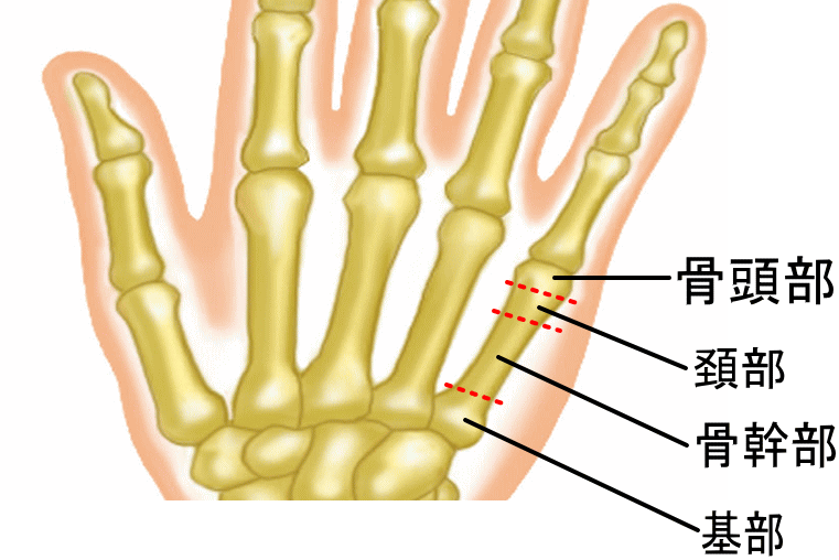 中手骨基部骨折 手の打撲と思っていたら 骨折だった 古東整形外科 リウマチ科