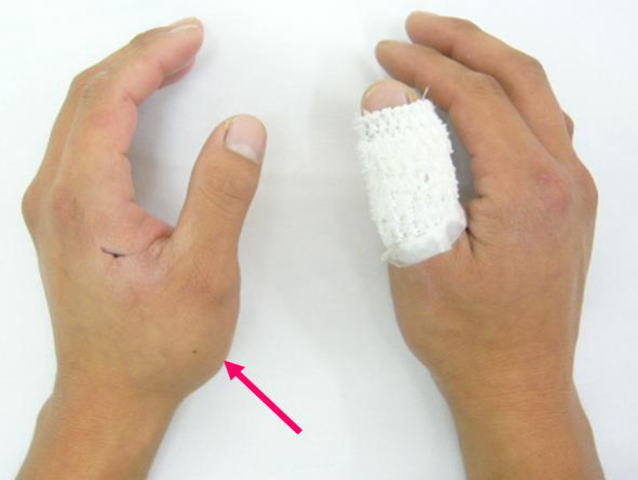 第一中手骨基部骨折 親指の付け根を骨折してしまった ギプスか手術かどっちがいいの 古東整形外科 リウマチ科