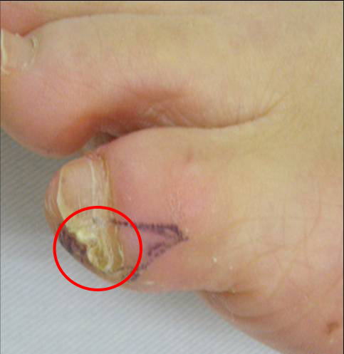 副爪 足の小趾が靴に当たって 我慢できないぐらい痛い 古東整形外科 リウマチ科