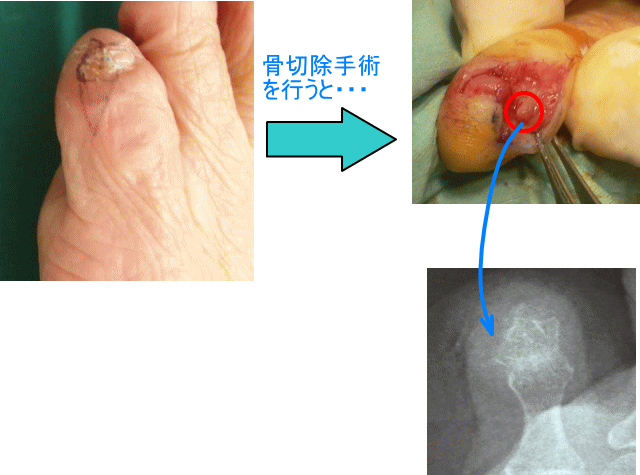 副爪 足の小趾が靴に当たって 我慢できないぐらい痛い 古東整形