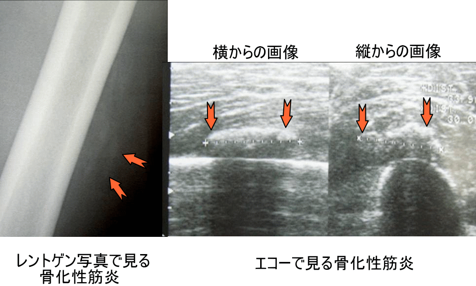 骨化性筋炎 大腿部の打撲だと思っていたが なかなか痛みがとれない なんで 古東整形外科 リウマチ科