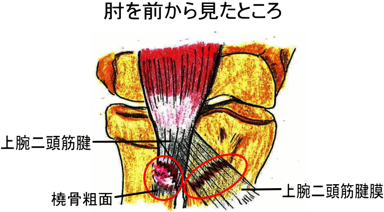 上腕二頭筋腱断裂 力こぶの形が何かおかしい 古東整形外科 リウマチ科