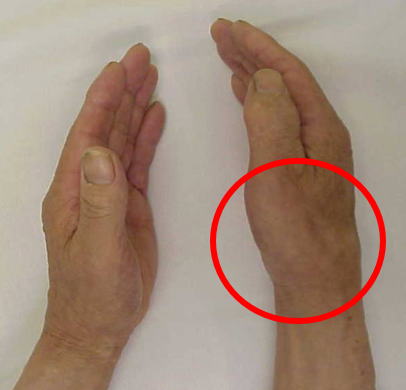 右足親指の付け根が痛い 原因