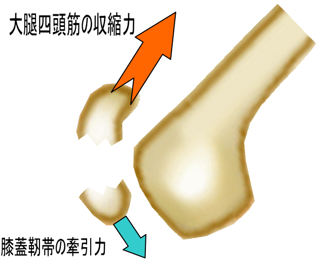 古東整形外科・リウマチ科膝蓋骨骨折の分類膝蓋骨骨折の特徴膝蓋骨骨折の治療では、こういったギプスを巻きます。膝蓋骨骨折で膝の違和感や腫れが長く続くこともあります。