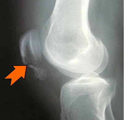 膝蓋骨骨折 膝を地面に強く打って 歩けない 古東整形外科 リウマチ科