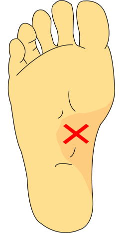 足底線維腫 足の裏が痛い でも 足底腱膜炎ではありませんよ 古東整形外科 リウマチ科
