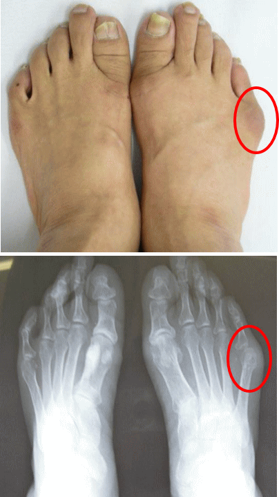 内反小趾 足の小趾が靴に当たって痛い 古東整形外科 リウマチ科