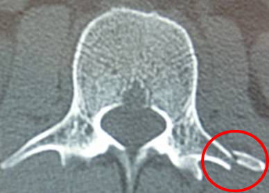 腰椎横突起骨折 腰を打って 打撲だと思っていたら 骨折していた 古東整形外科 リウマチ科