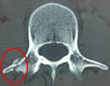 腰椎横突起骨折 腰を打って 打撲だと思っていたら 骨折していた 古東整形外科 リウマチ科