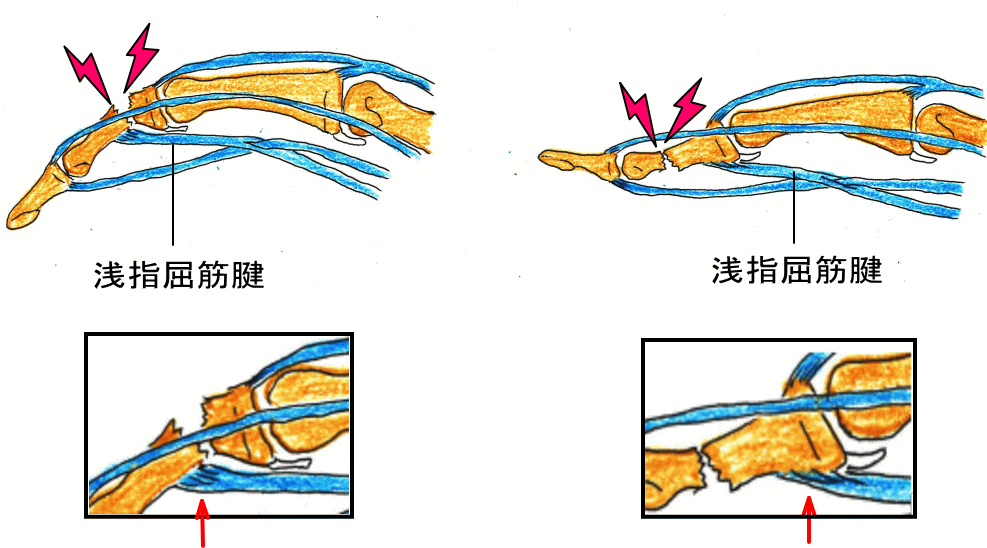 中節骨骨折 ドアに挟まって指が痛い 古東整形外科 リウマチ科